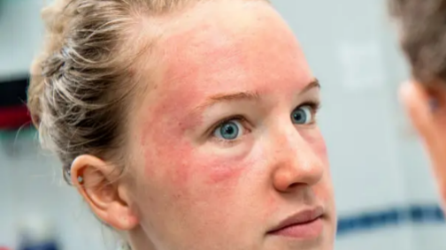 Peau atopique, eczéma, psoriasis : quelle solution douce pour nettoyer sans agresser ?