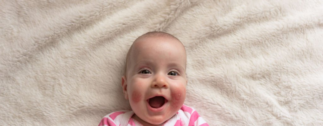 Eczéma, peau atopique en été : quelle routine naturelle sans cortisone pour apaiser la peau (bébé, enfant et adulte) ?