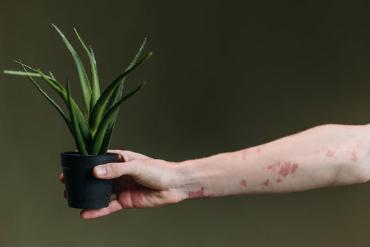 Poussé d'eczéma et peau atopique : comment apaiser les démangeaisons naturellement sans cortisone ni parfum ?