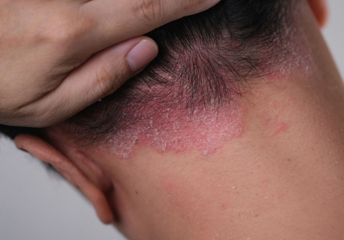 Psoriasis du cuir chevelu : que faire contre les plaques, squames et démangeaisons ?